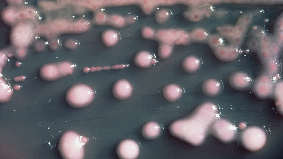 Klebsiella brain abscess case traced to evolved UTI bacteria